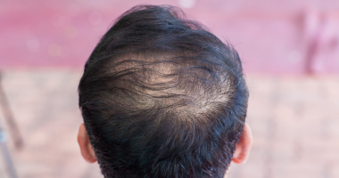 饮食如何影响你的头发？科学家警告：含糖饮料会增加脱发风险